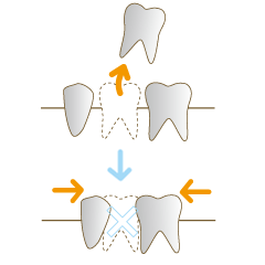歯を削ることなくしっかり咬み合わせを回復できるの画像
